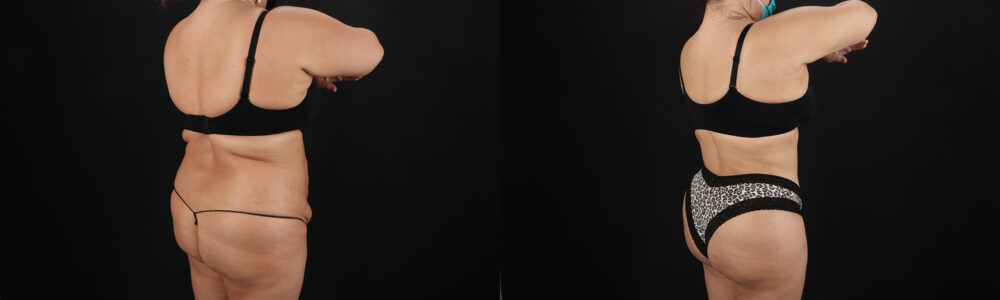 Tummy Tuck case #259095