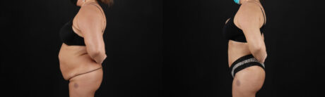 Tummy Tuck case #259095