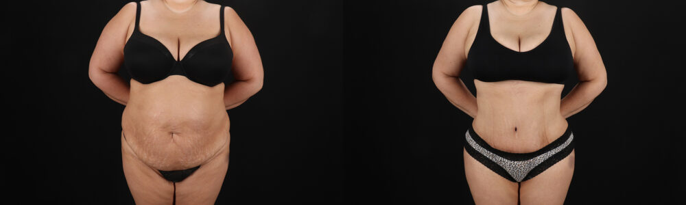 Tummy Tuck case #259095