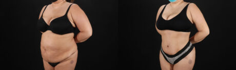 Tummy Tuck case #259095