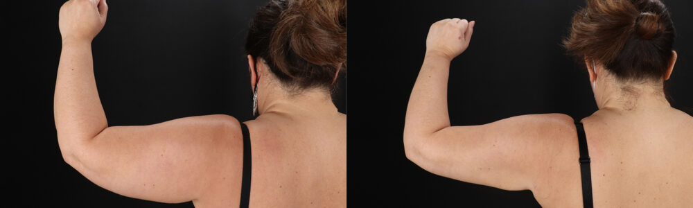 Tummy Tuck case #259095