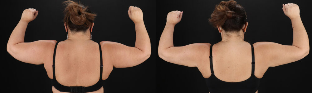 Tummy Tuck case #259095