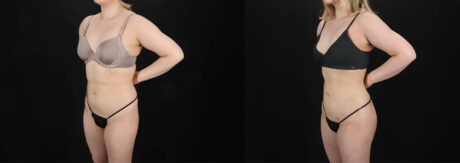 Brazilian Butt Lift case #258772