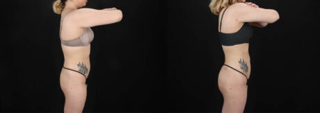 Brazilian Butt Lift case #258772