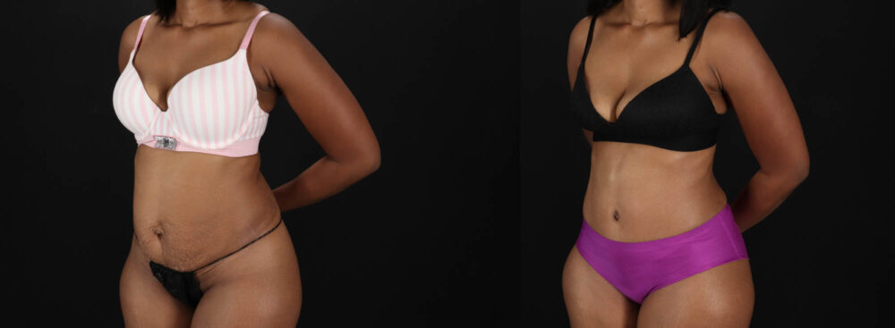 Tummy Tuck case #260120