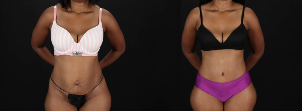 Tummy Tuck case #260120