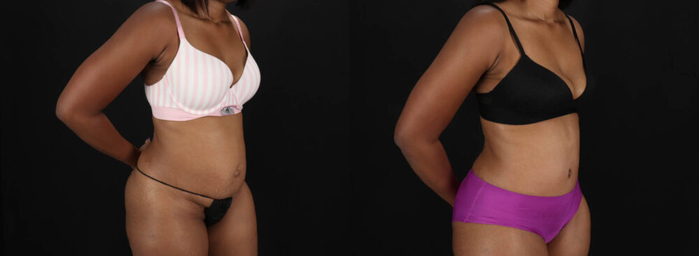 Tummy Tuck case #260120