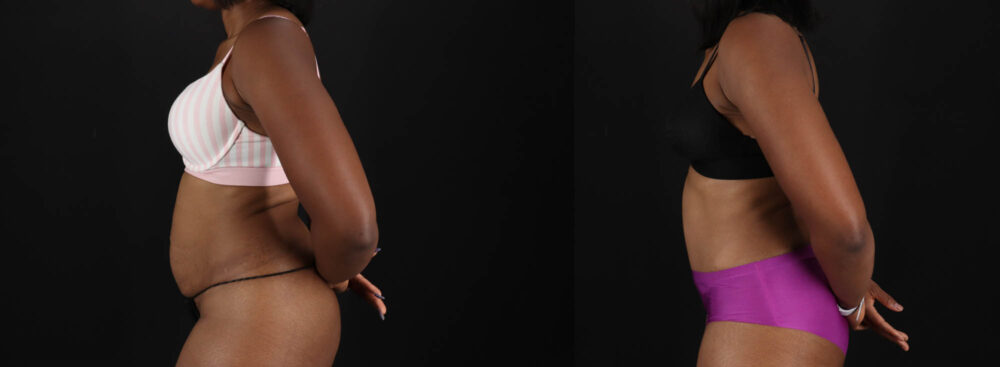 Tummy Tuck case #260120