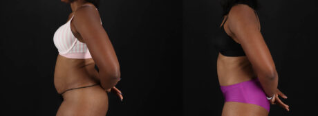 Tummy Tuck case #260120