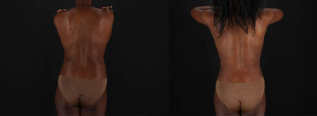 Mommy Makeover case #260092