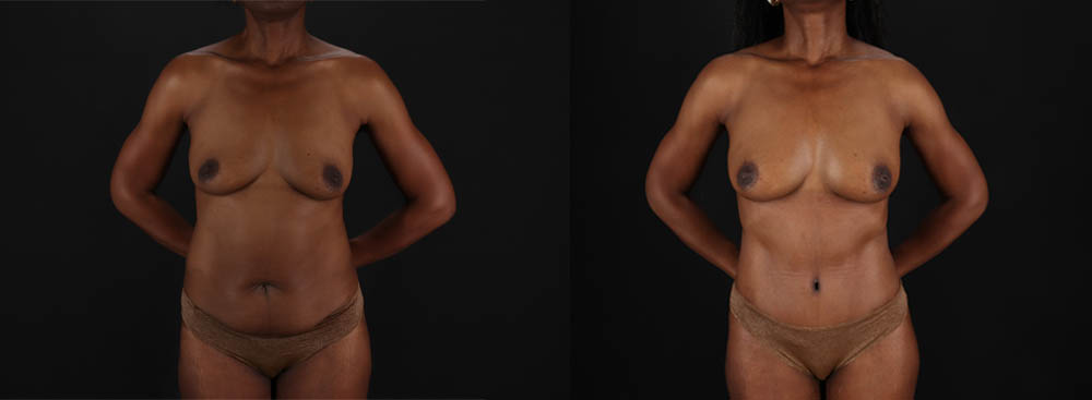 Mommy Makeover case #260092