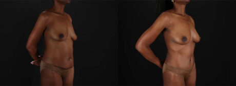 Mommy Makeover case #260092