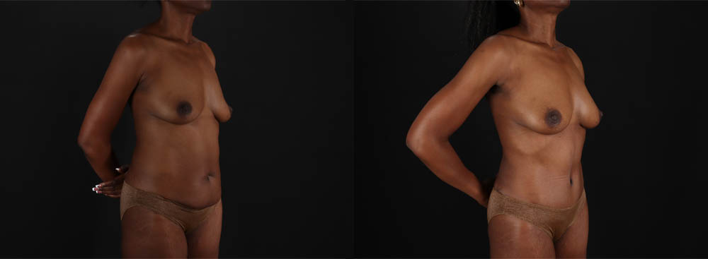 Mommy Makeover case #260092