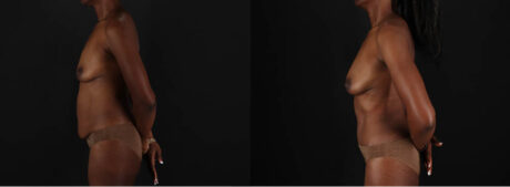 Mommy Makeover case #260092