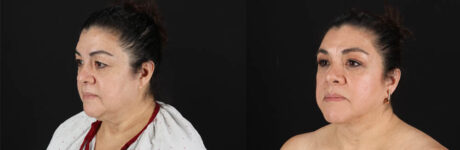 Renuvion RF Skin Tightening case #260099