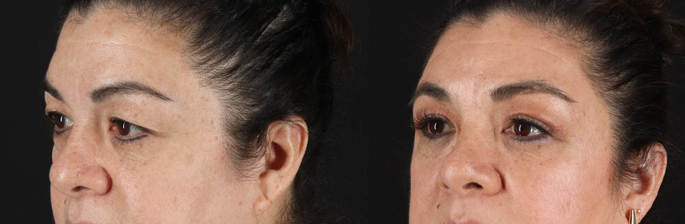 Blepharoplasty case #260106