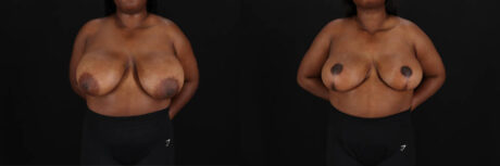 Breast Reduction case #260069