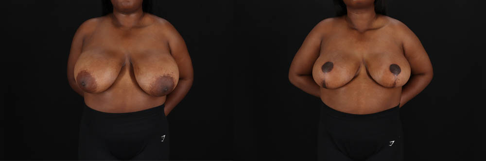 Breast Reduction case #260069