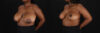 Breast Reduction case #260069 slider thumbnail