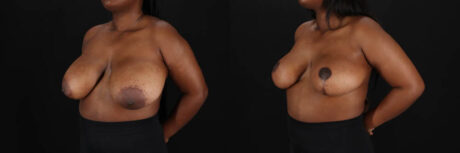 Breast Reduction case #260069