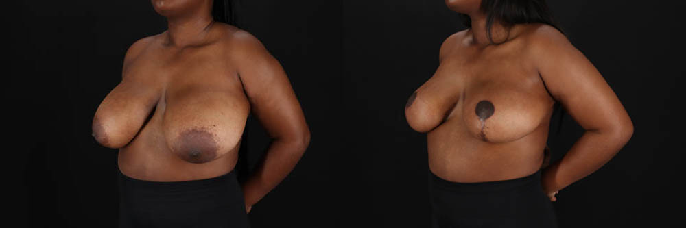Breast Reduction case #260069