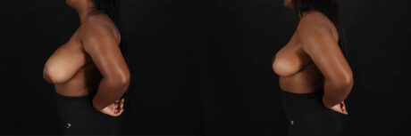 Breast Reduction case #260069