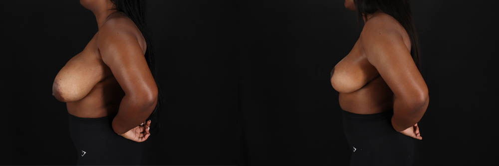 Breast Reduction case #260069