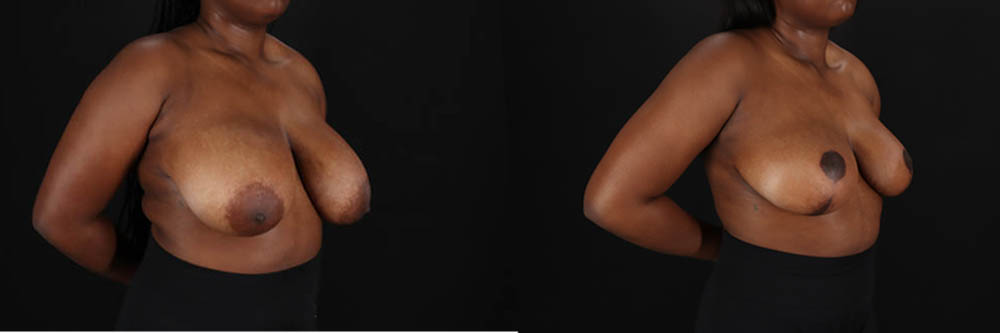Breast Reduction case #260069