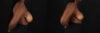 Breast Reduction case #260069 slider thumbnail