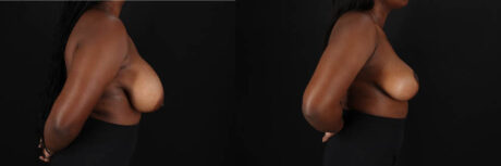 Breast Reduction case #260069