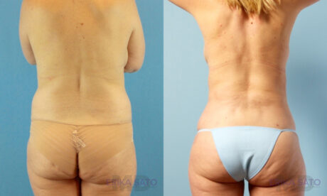 Fat Grafting to the Breast case #261036