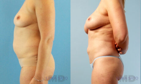 Fat Grafting to the Breast case #261036