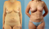 Fat Grafting to the Breast case #261036 slider thumbnail