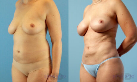 Fat Grafting to the Breast case #261036