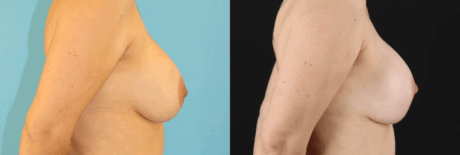 Breast Lift with Implants case #261019