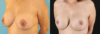 Breast Lift with Implants case #261019 slider thumbnail
