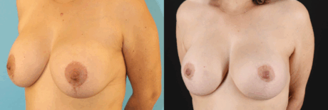Breast Lift with Implants case #261019