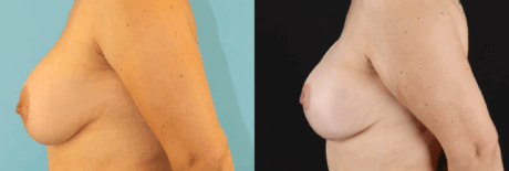 Breast Lift with Implants case #261019