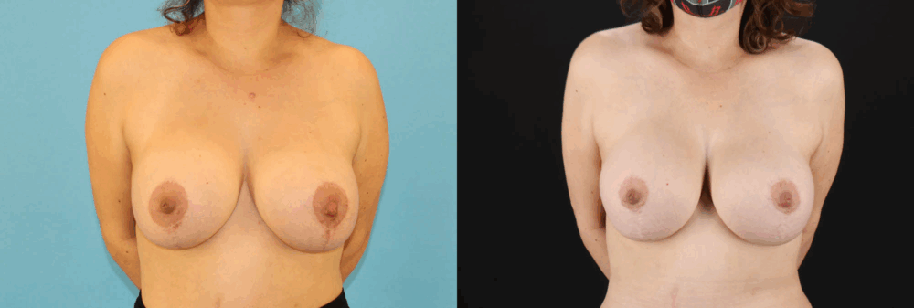 Breast Lift with Implants case #261019