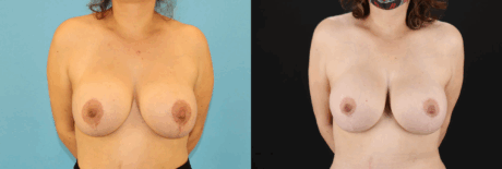 Breast Lift with Implants case #261019