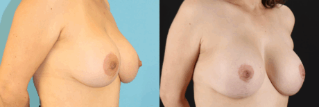 Breast Lift with Implants case #261019