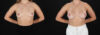 Breast Augmentation case #261355 slider thumbnail