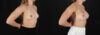 Breast Augmentation case #261355 slider thumbnail