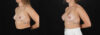 Breast Augmentation case #261355 slider thumbnail