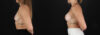 Breast Augmentation case #261355 slider thumbnail
