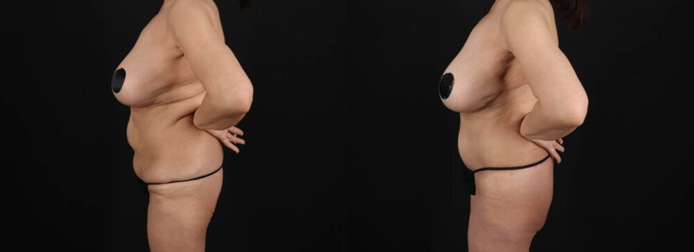 Post Bariatric Surgery (Massive Weight Loss) case #261401