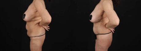 Post Bariatric Surgery (Massive Weight Loss) case #261401