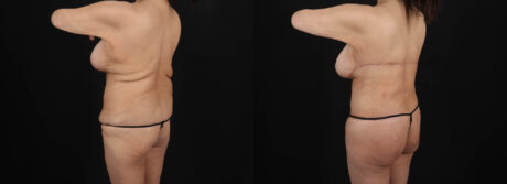 Post Bariatric Surgery (Massive Weight Loss) case #261401