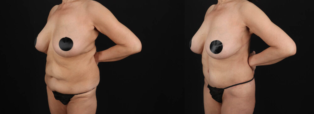 Post Bariatric Surgery (Massive Weight Loss) case #261401