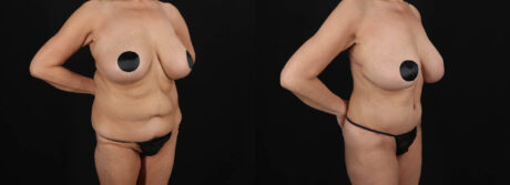 Post Bariatric Surgery (Massive Weight Loss) case #261401